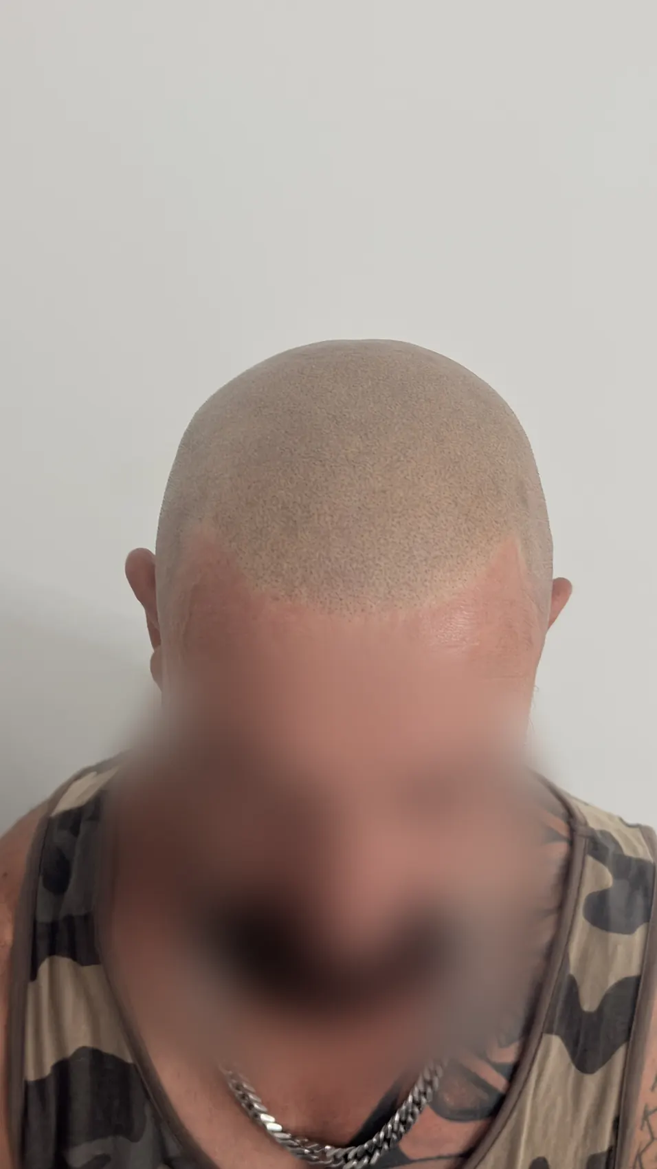 Lo stesso cliente dopo la tricopigmentazione, effetto rasato