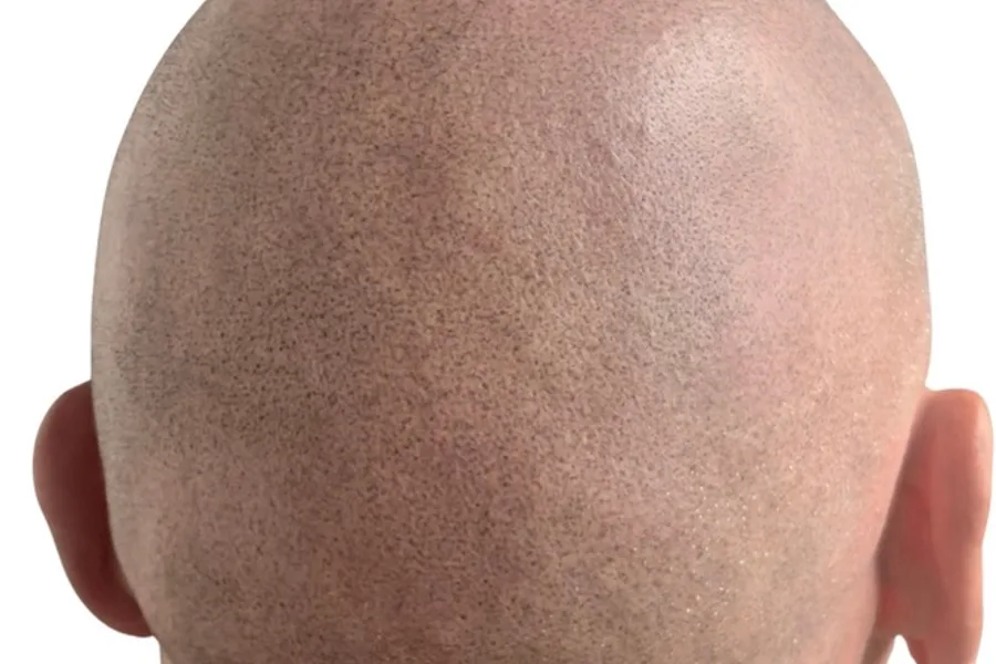 Risultato su alopecia areata