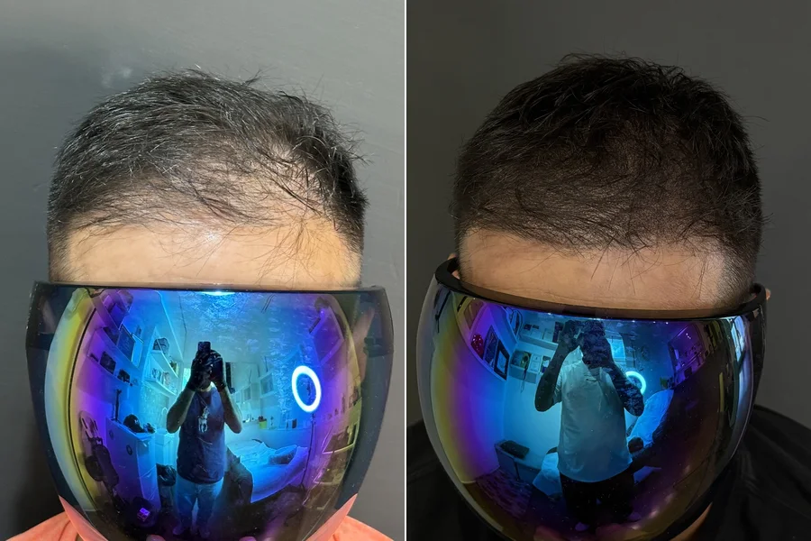 Prima e dopo: effetto densità sui capelli radi